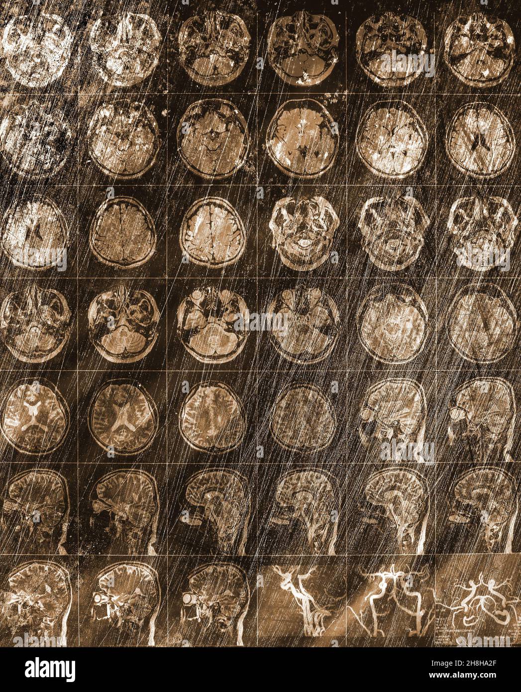 CT-Scan des menschlichen Kopfes auf dem veralteten rostigen metallischen Hintergrund. Stockfoto