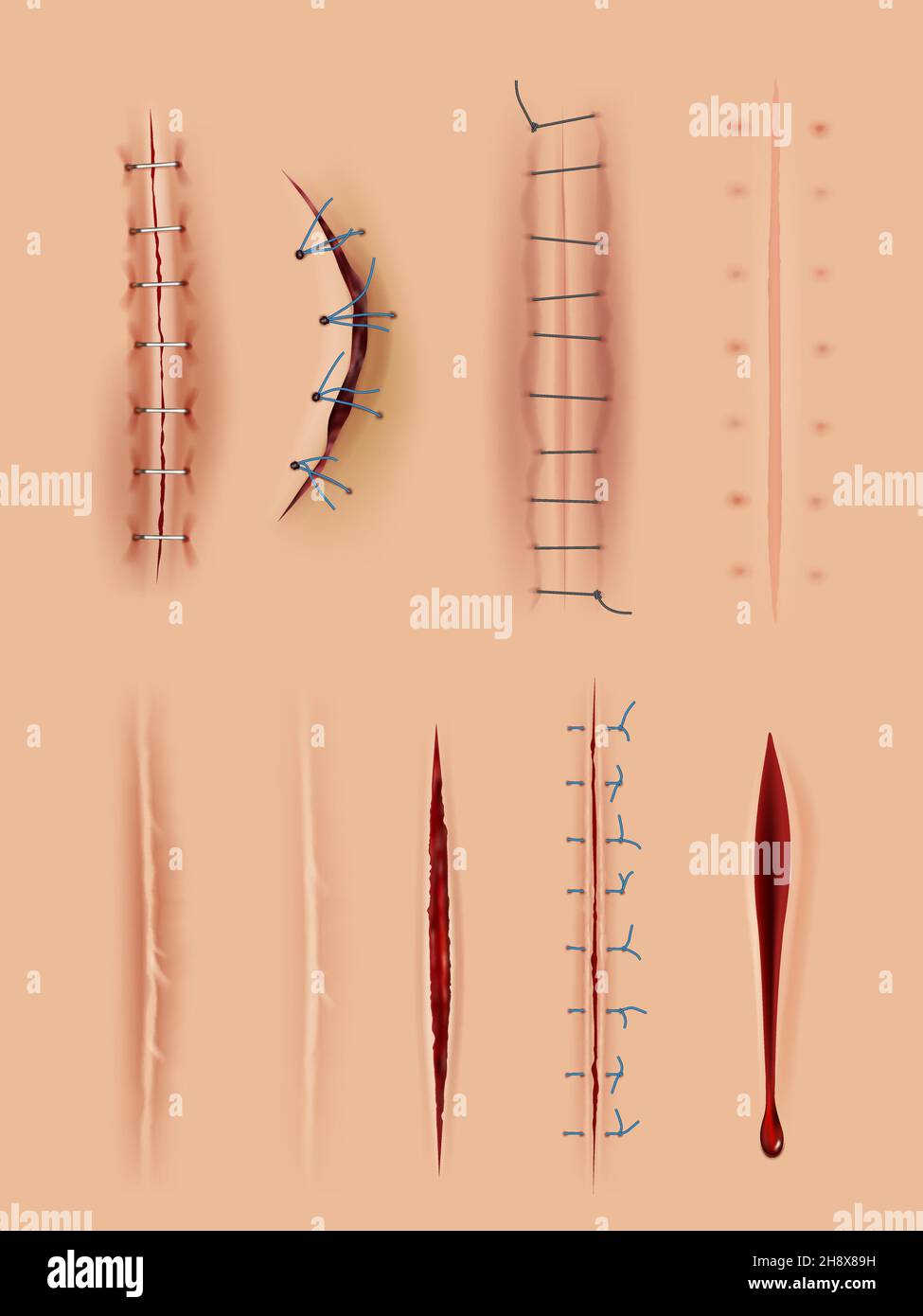 Realistische Narben. Medizinische chirurgische Nähte Wunden Nahaufnahme Bilder auf der menschlichen Haut anständige Vektor-Illustrationen-Set Stock Vektor