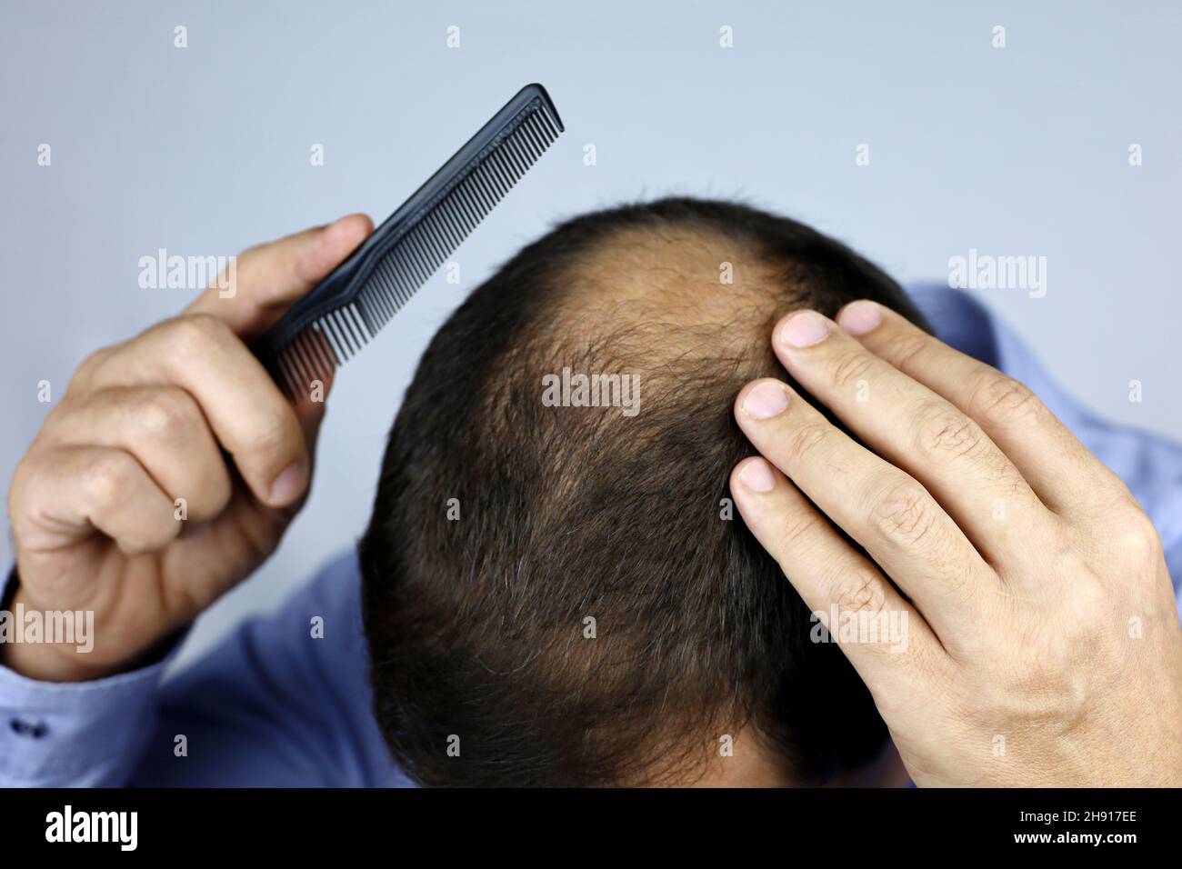 Kahlheit, Mann kämmt seinen Kopf mit einem Kamm. Männliche Hand auf einer Glatze, Person besorgt über Haarausfall Stockfoto
