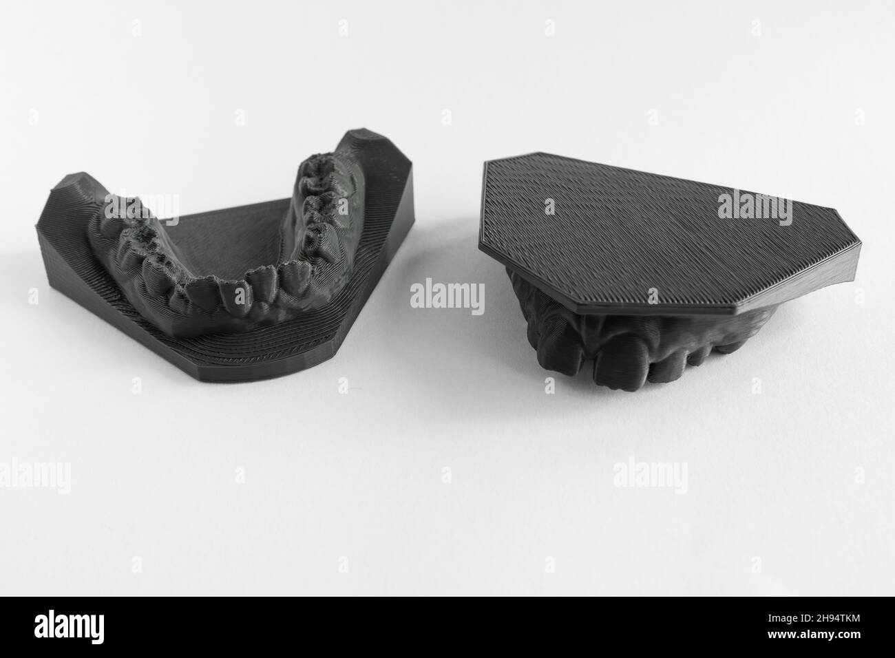 3D Drucker Prothese Mädchen 9 Jahre Zahnmedizin Stockfoto