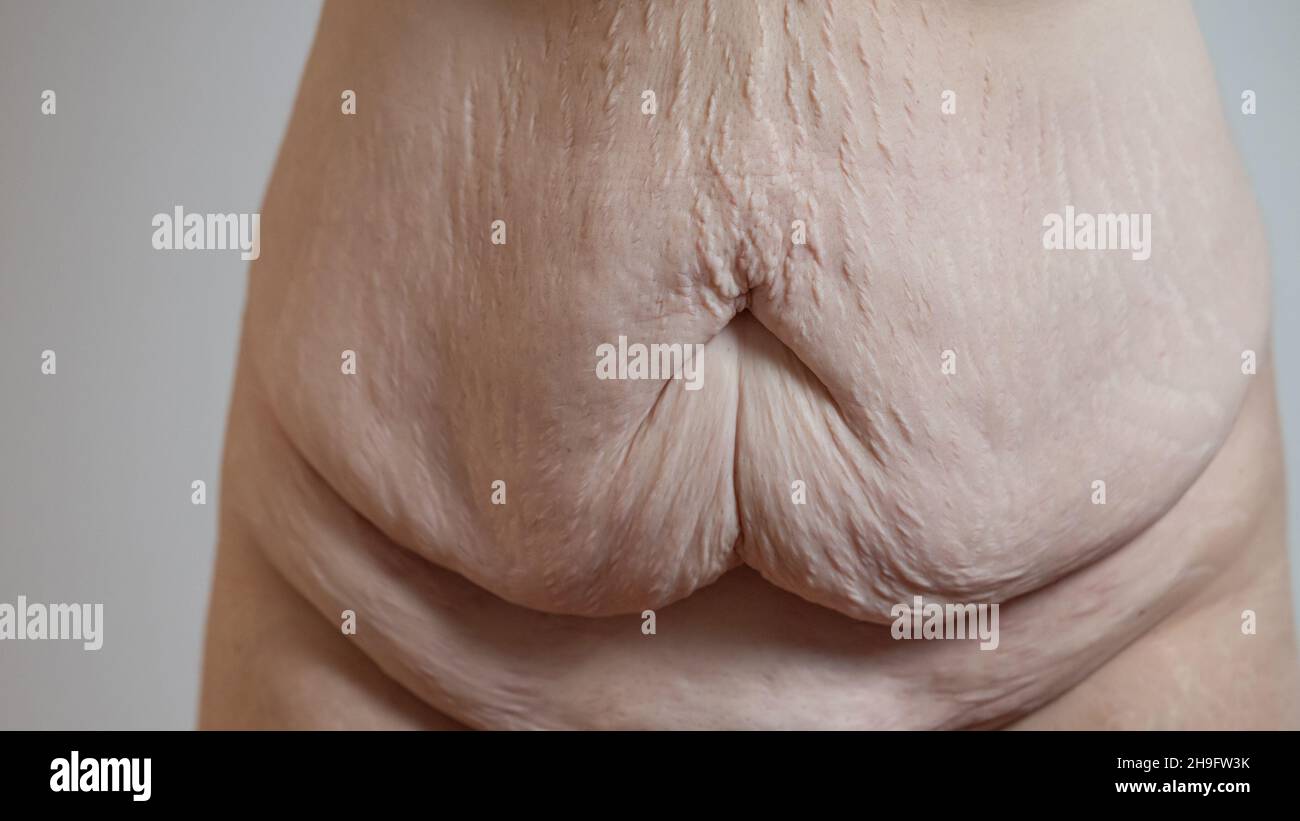 Schlaffe Haut nach dem Verlust von schwerem Gewicht auf Bauch oder Bauchbereich eines Körpers. Sichtbare schlaffe Haut am Bauch und um den Bauchnabel. Stockfoto