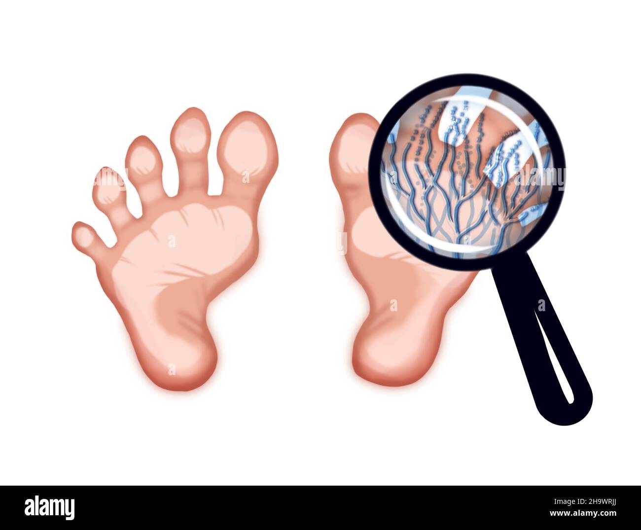 Abbildung eines Fußes, der von einem Pilz betroffen ist Stockfoto