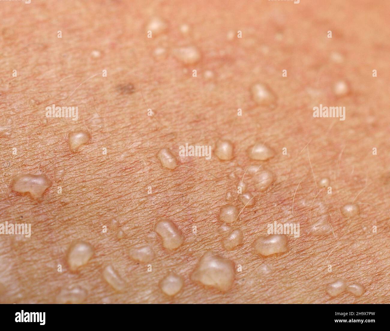 Blasen auf der haut Fotos und Bildmaterial in hoher Auflösung Alamy