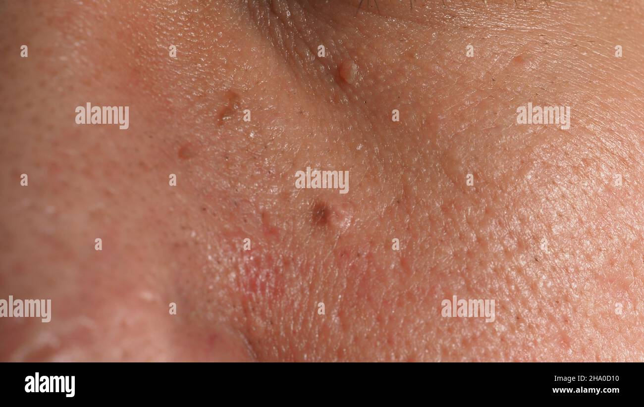 Bilder Von Warzen Im Gesicht www.alamy.de