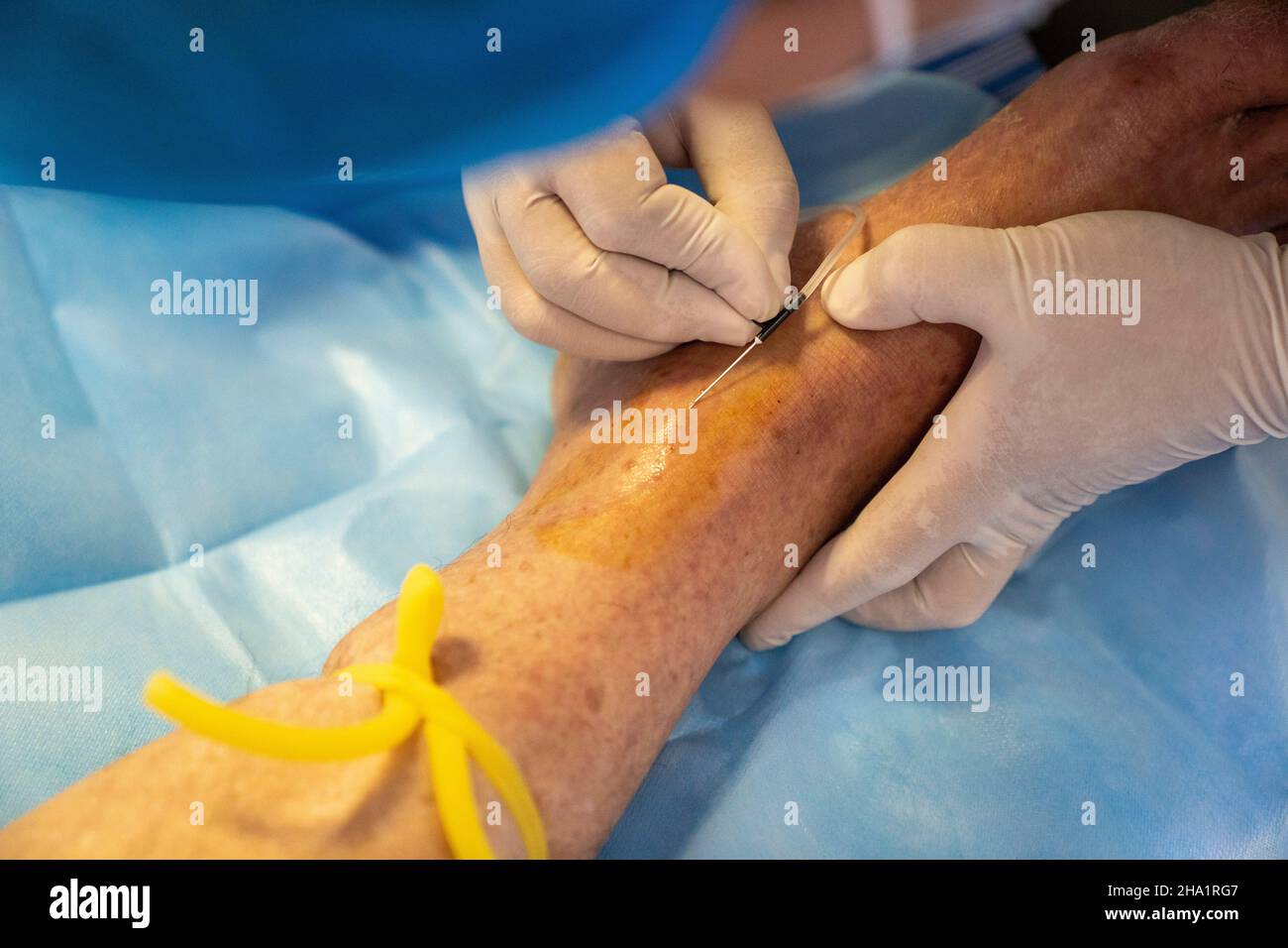 ENSHI, CHINA - 23. JUNI 2020 - Eine Krankenschwester entnimmt Blut aus einer Intensivstation in der Stadt Enshi, Provinz Hubei, China, 23. Juni 2020. Stockfoto