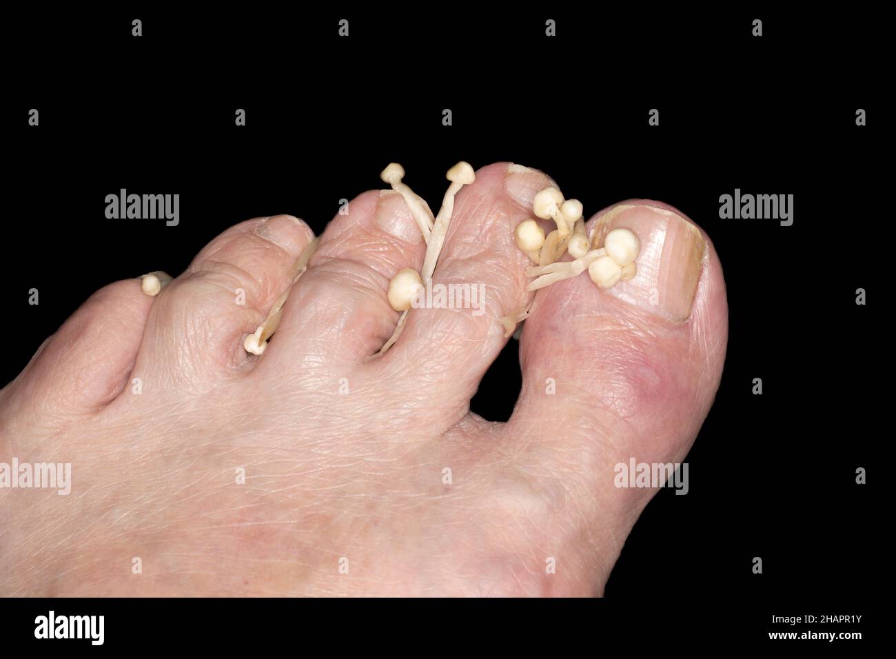Symbolisches Foto, Onychomykose, auch bekannt als Tinea unguium, Pilzinfektion des Nagels Stockfoto