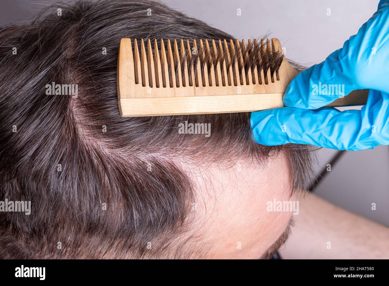 Kahlheit oder Haarausfall beim Menschen - ein Arzt in blauen medizinischen Handschuhen untersucht die Haare und die Kopfhaut eines Mannes, Nahaufnahme, Draufsicht. Der Arzt verwendet zur Untersuchung einen Kamm Stockfoto