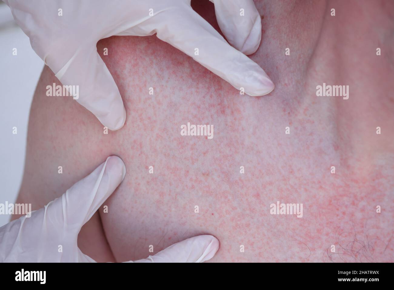 Arzt Hände in Handschuhen, die roten Hautausschlag auf der Haut des Patienten untersuchen Stockfoto