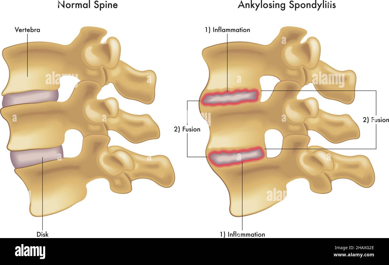 Medizinische Abbildung vergleicht eine normale Wirbelsäule mit einer, die die Schritte zeigt, die zu einer ankylosierenden Spondylitis führen. Stock Vektor