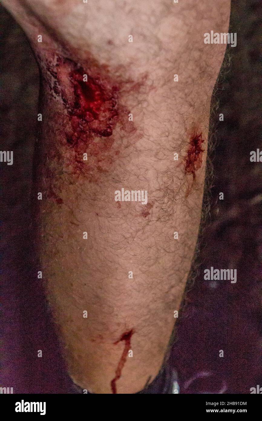 Das menschliche Bein ist durch Blutegel im Dschungel des Nationalparks Taman Negara in Malaysia mit Blut bedeckt Stockfoto