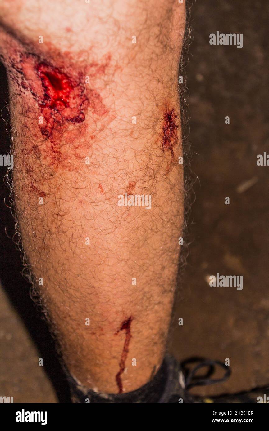 Das menschliche Bein ist durch Blutegel im Dschungel des Nationalparks Taman Negara in Malaysia mit Blut bedeckt Stockfoto