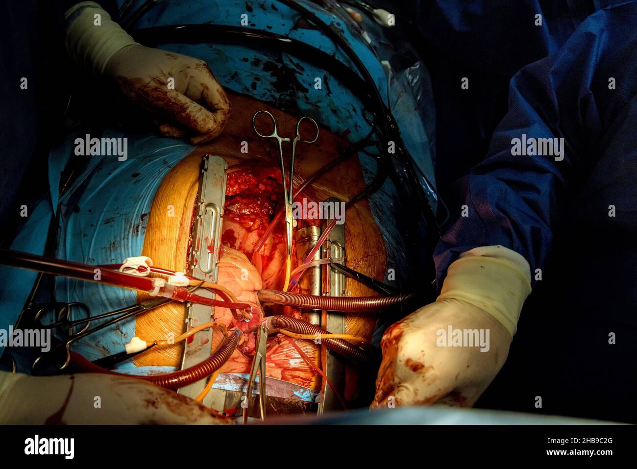 Operation am offenen Herzen mit verschiedenen Operationsröhrchen, die an ein Herz mit Herzumgehung der Koronararterie angeschlossen sind Stockfoto