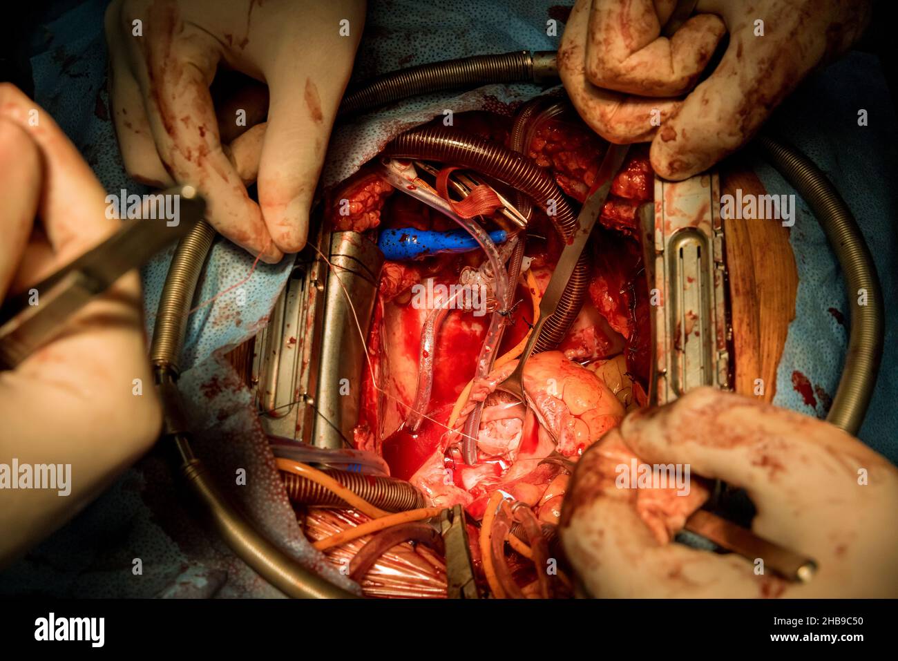 Nahaufnahme der Implantation einer biologischen Herzklappenchirurgie Herz-Kreislauf-Chirurgie am offenen Herzen Stockfoto
