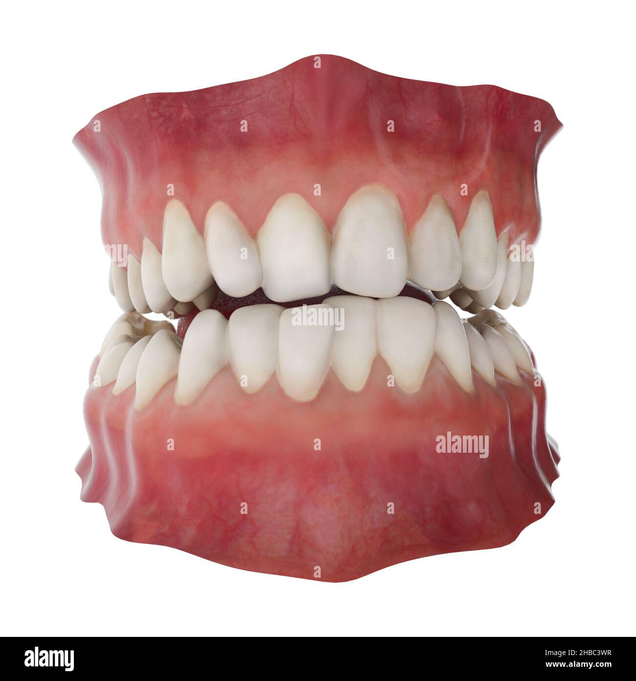 Kiefer mit anormaler Zahnstellung. Kieferorthopädisches Behandlungskonzept. Realistische Abbildung 3D Stockfoto