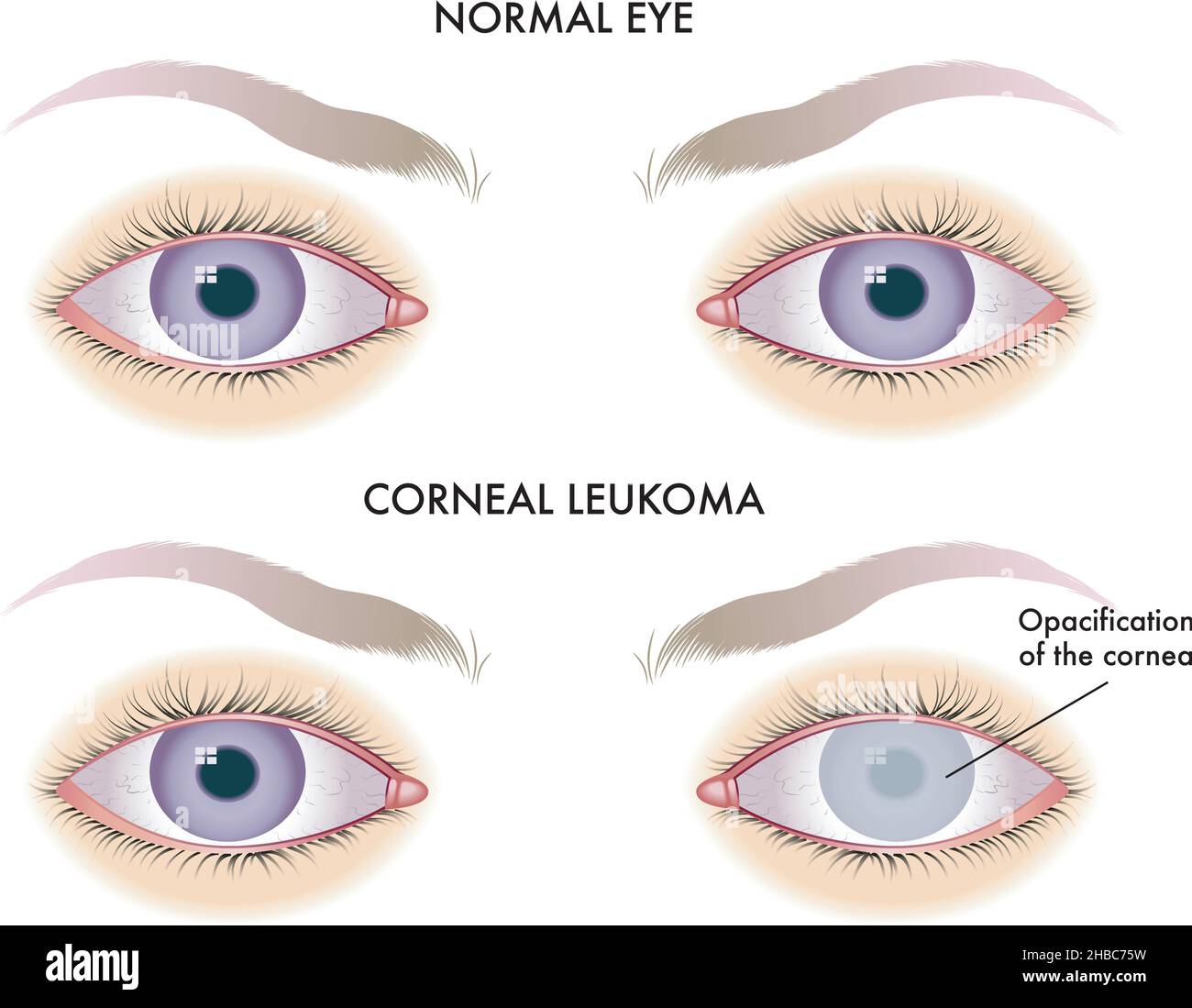 Medizinische Darstellung einer der möglichen Folgen des kornealen Leukoms auf das Auge. Stock Vektor