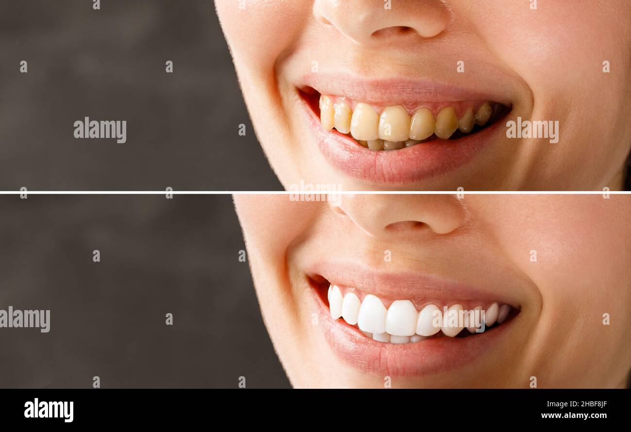 Frau Zähne vor und nach dem Aufhellen. Patient in der Zahnklinik. Bild symbolisiert Zahnheilkunde, Stomatologie. Stockfoto