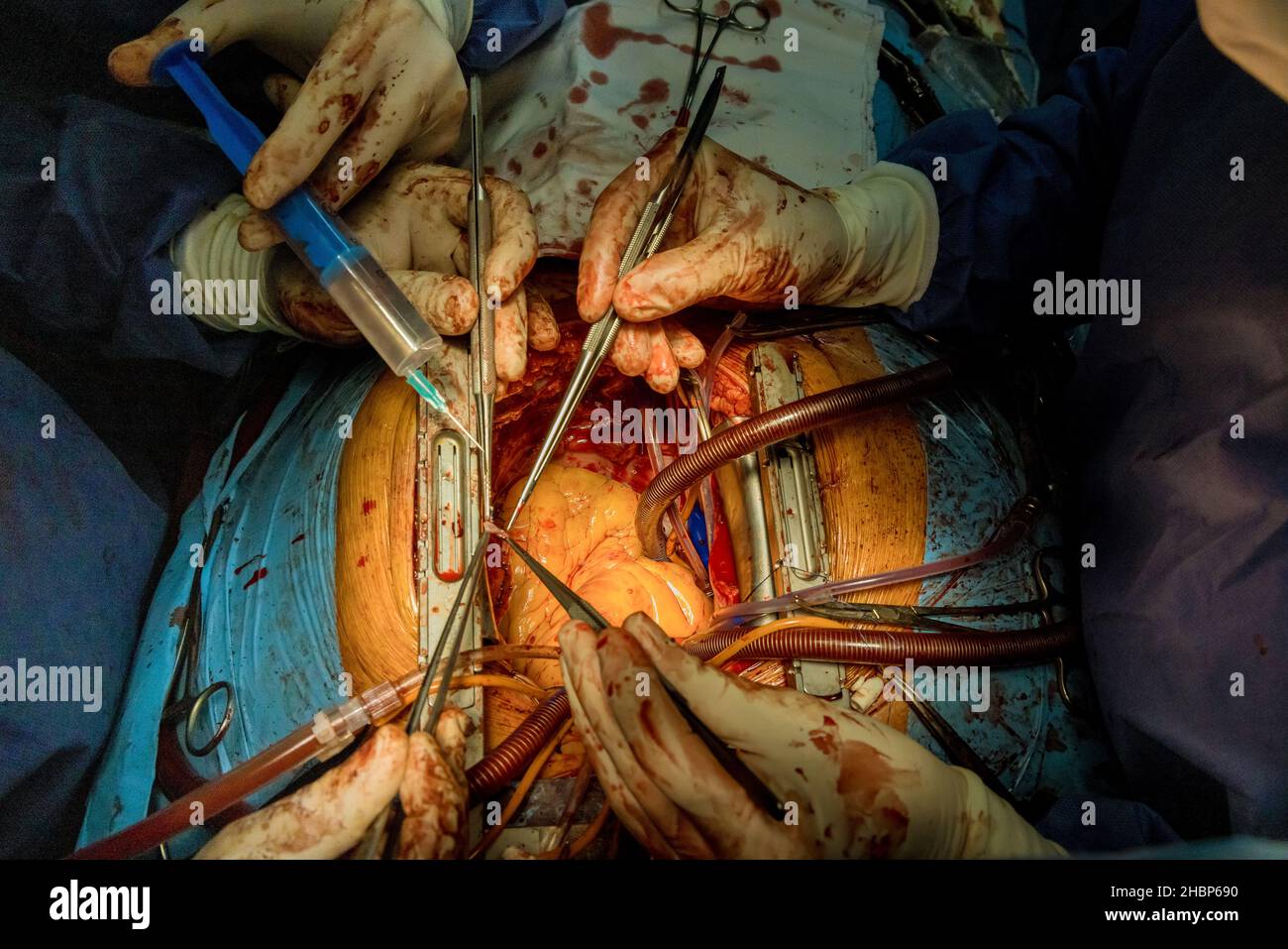 Während der Operation, Arzt Hände des offenen Herzens die Chirurgen Stockfoto