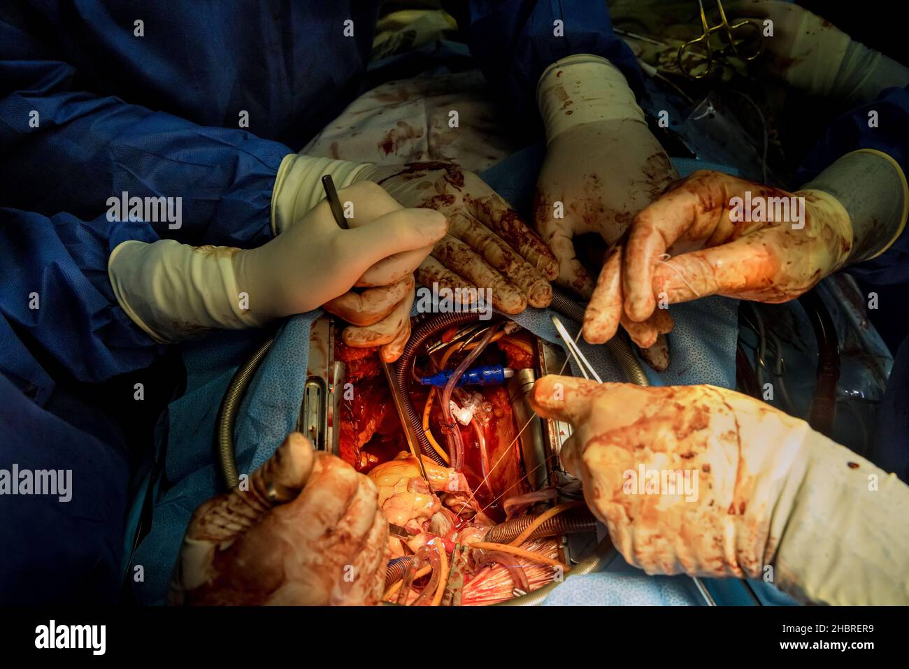 Der Chirurg die offene Herz-Eingriff Brust während der Herzoperation Stockfoto