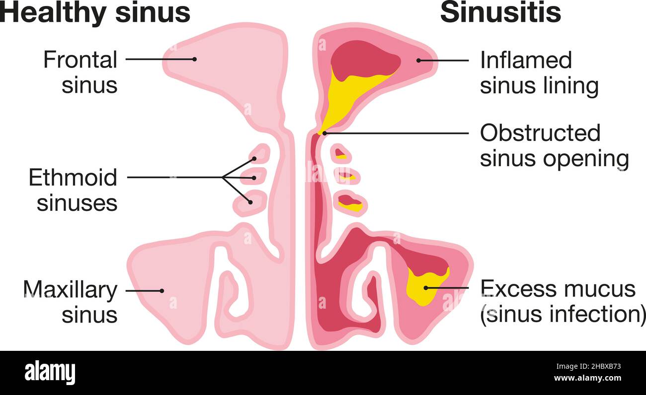 Vektor-Illustration zeigt gesunde Sinus und Sinusitis mit entzündeten Futter, verstopfte Sinusöffnung, Adinoid und überschüssigen Schleim Stockfoto