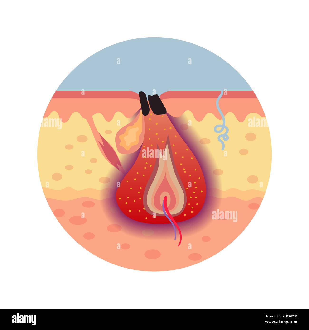 Propionibacterium acnes vulgaris. Schematische Darstellung des Entzündungsschwerpunkts unter der Haut. Entwicklung von Pickel. vector Medical Illustr Stock Vektor