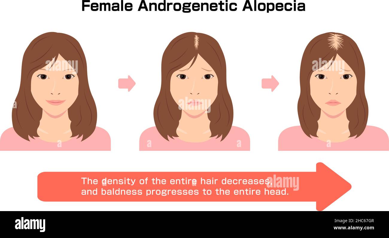 Fortschritt der weiblichen androgenetischen Alopezie. Vektorgrafik Stock Vektor
