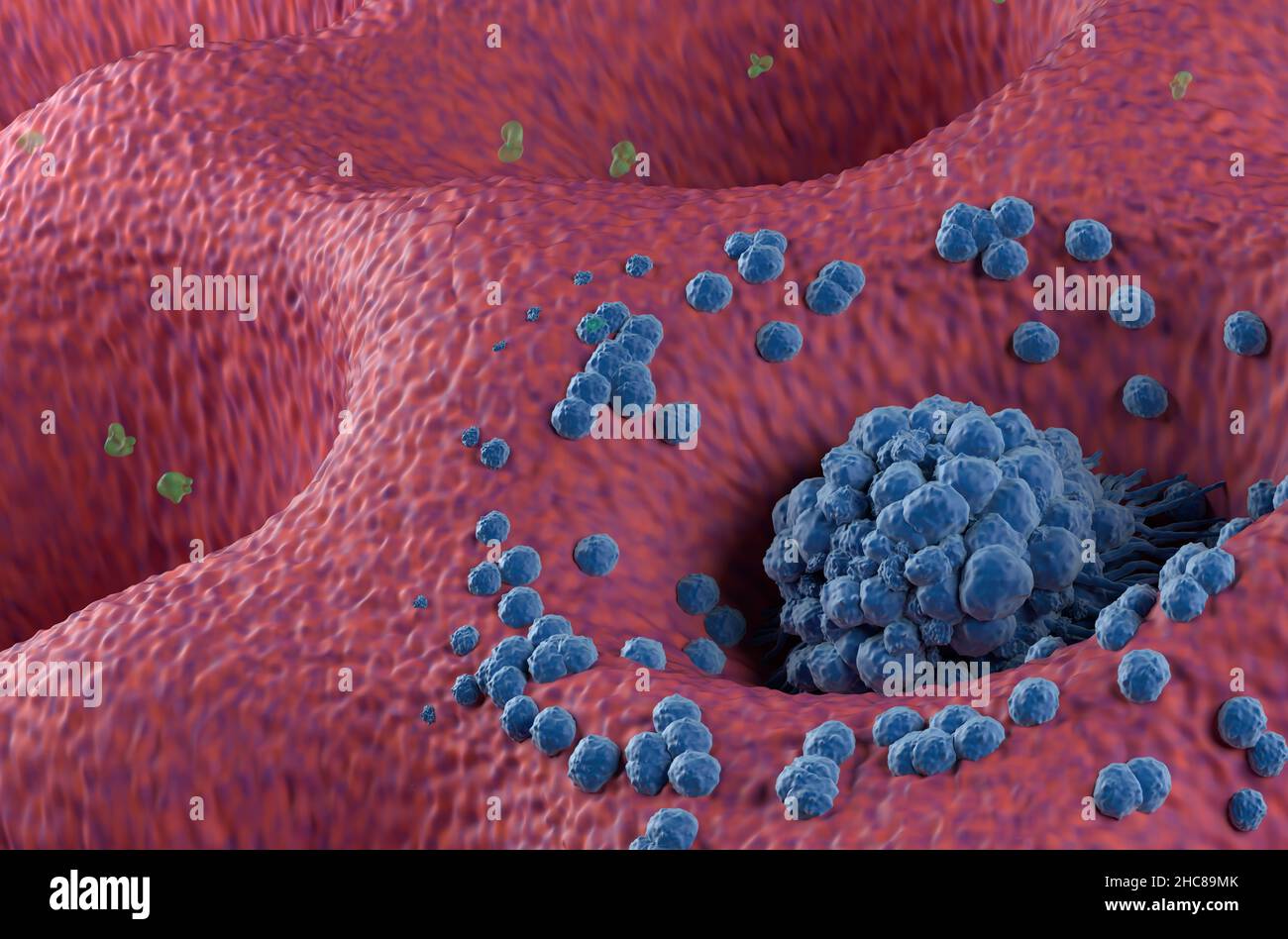 Magenkrebstumor im Frühstadium an der Magenwand Nahaufnahme Ansicht 3D Abbildung Stockfoto