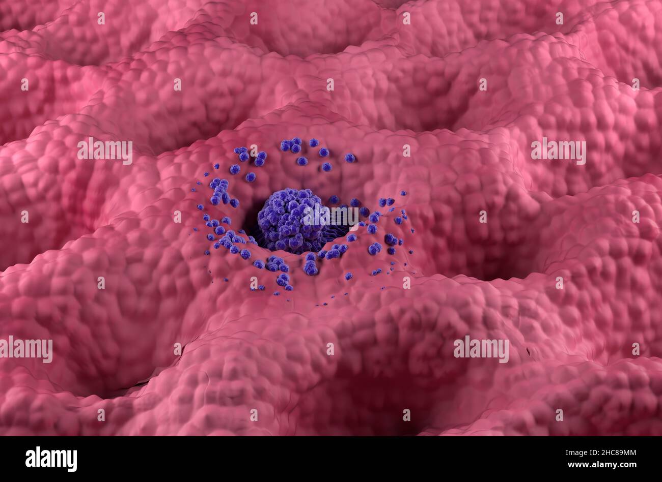 Magenkrebstumor im Frühstadium an der Magenwand Vorderansicht 3D Abbildung Stockfoto