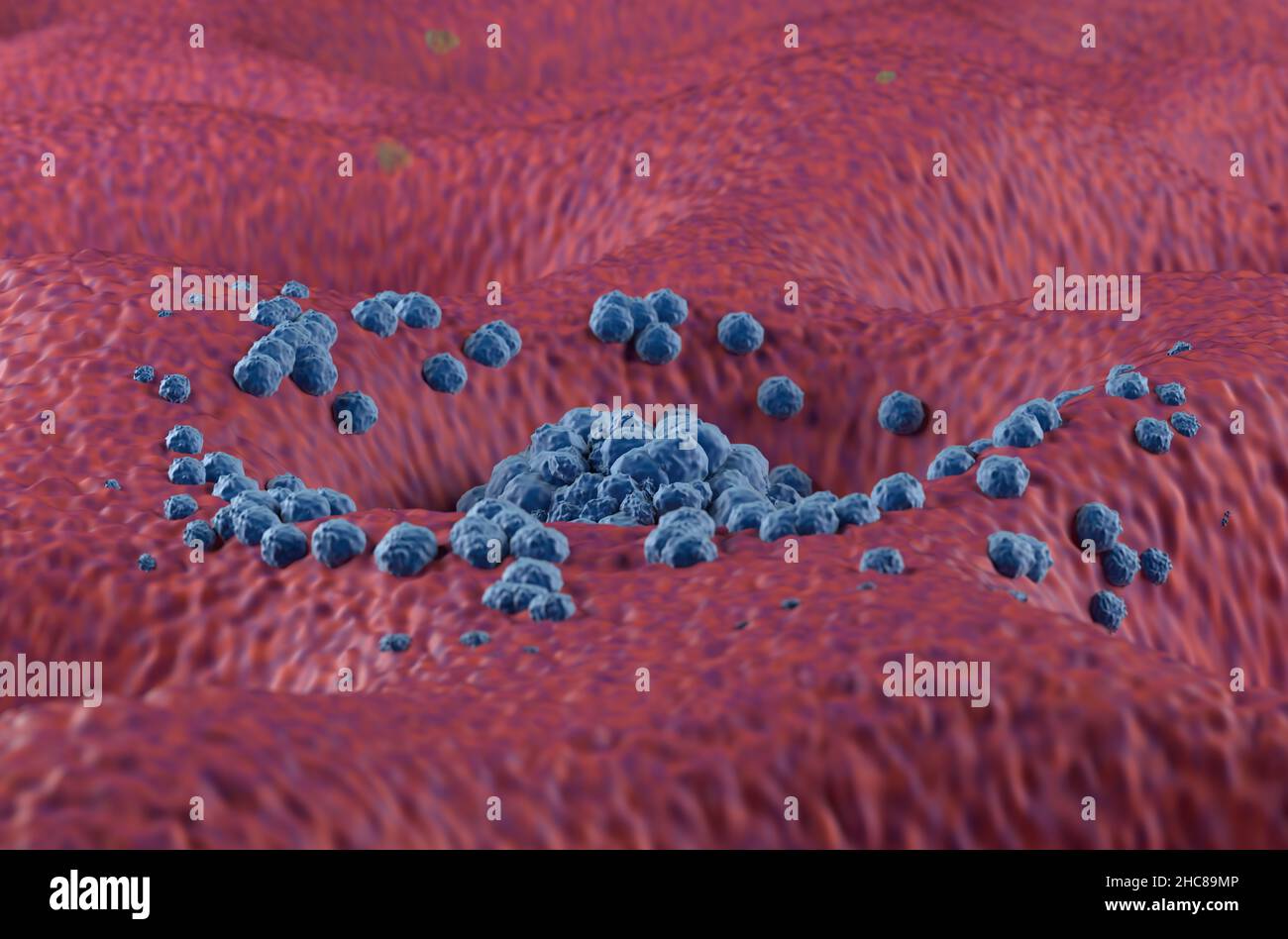 Magenkrebstumor im Frühstadium an der Magenwandseite Nahaufnahme Ansicht 3D Abbildung Stockfoto