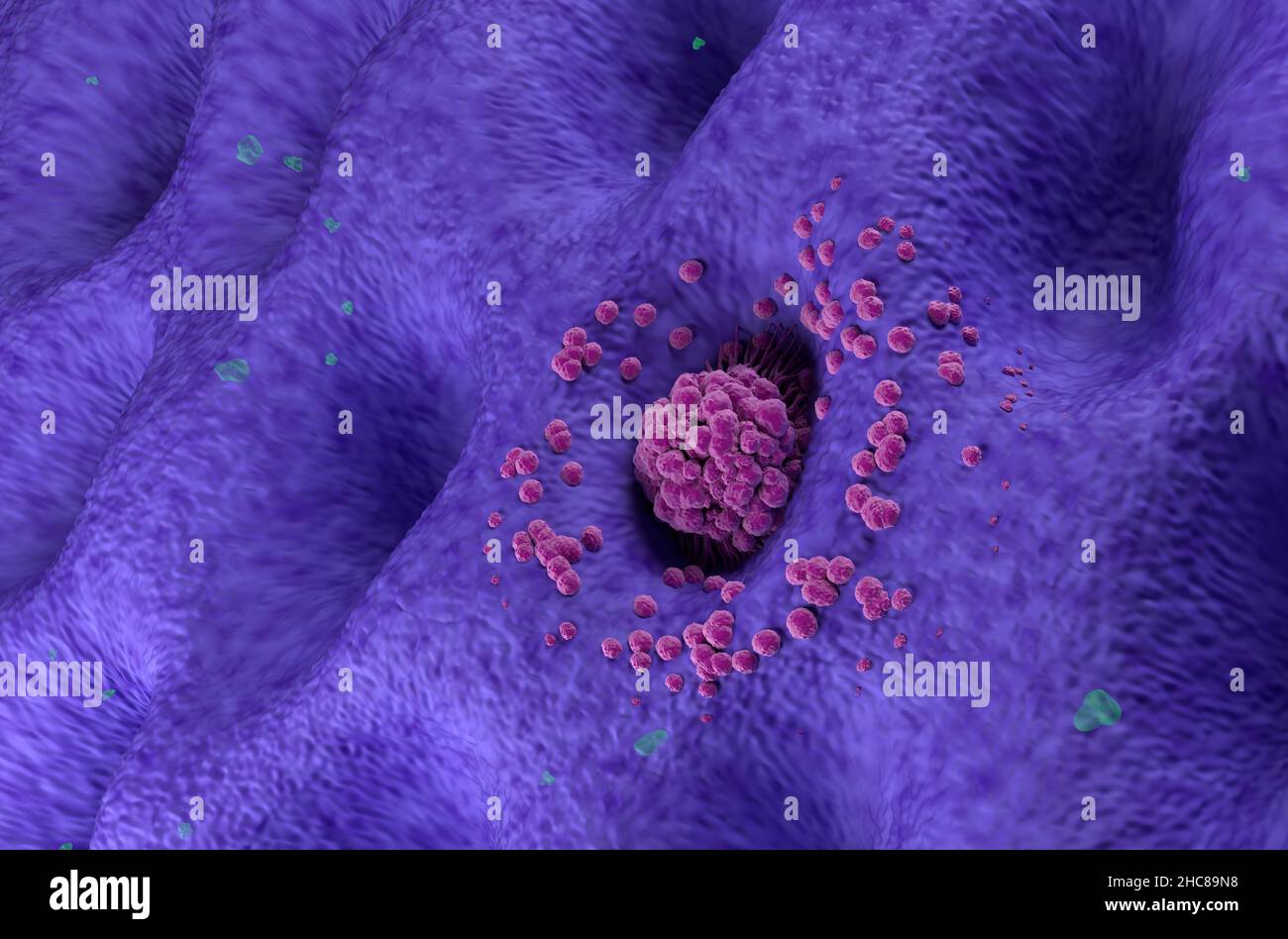 Magenkrebstumor im Frühstadium auf dem Magen Wandwinkel Ansicht 3D Abbildung Stockfoto
