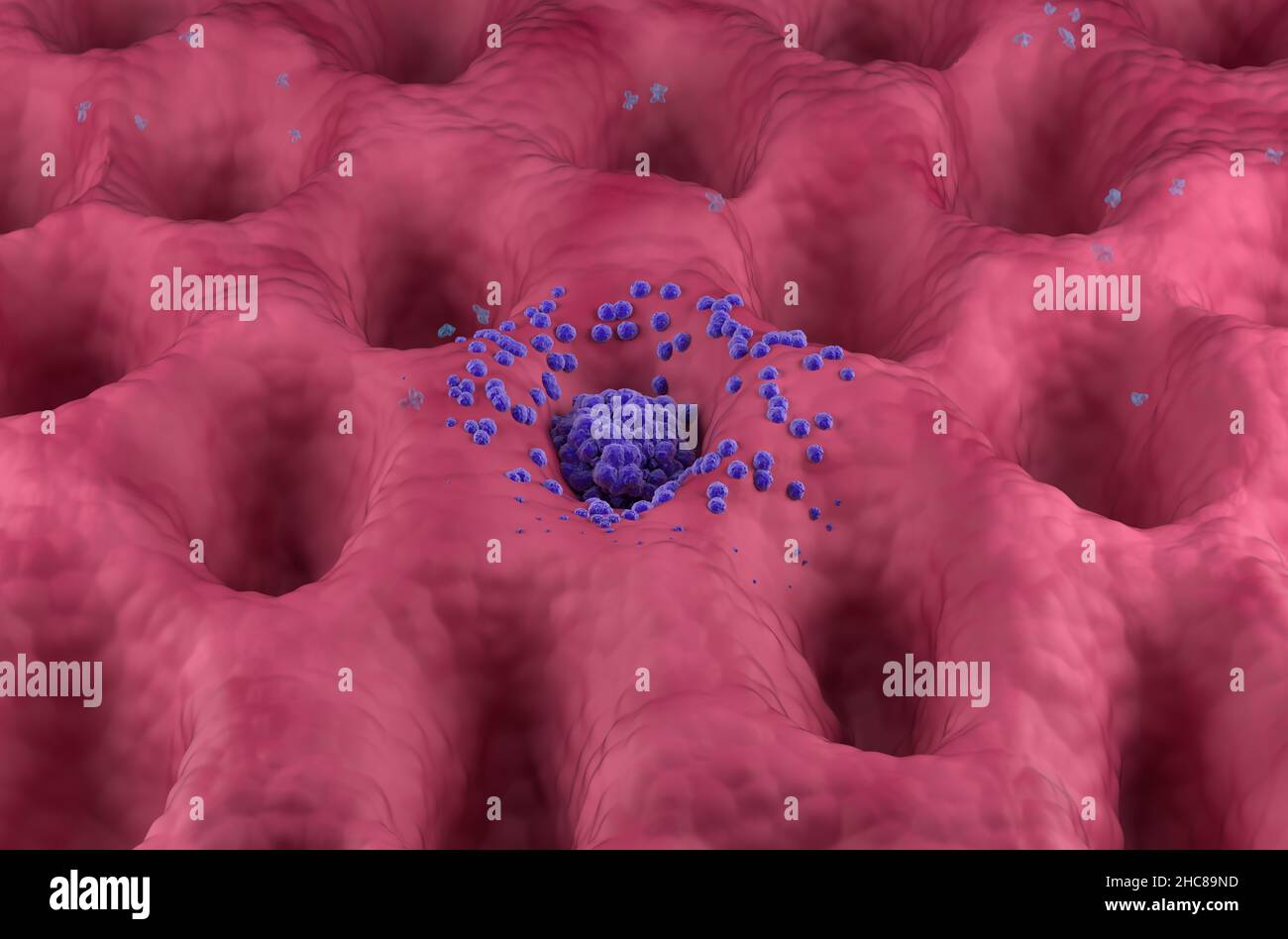 Magenkrebstumor im Frühstadium an der Magenwand Vorderansicht 3D Abbildung Stockfoto