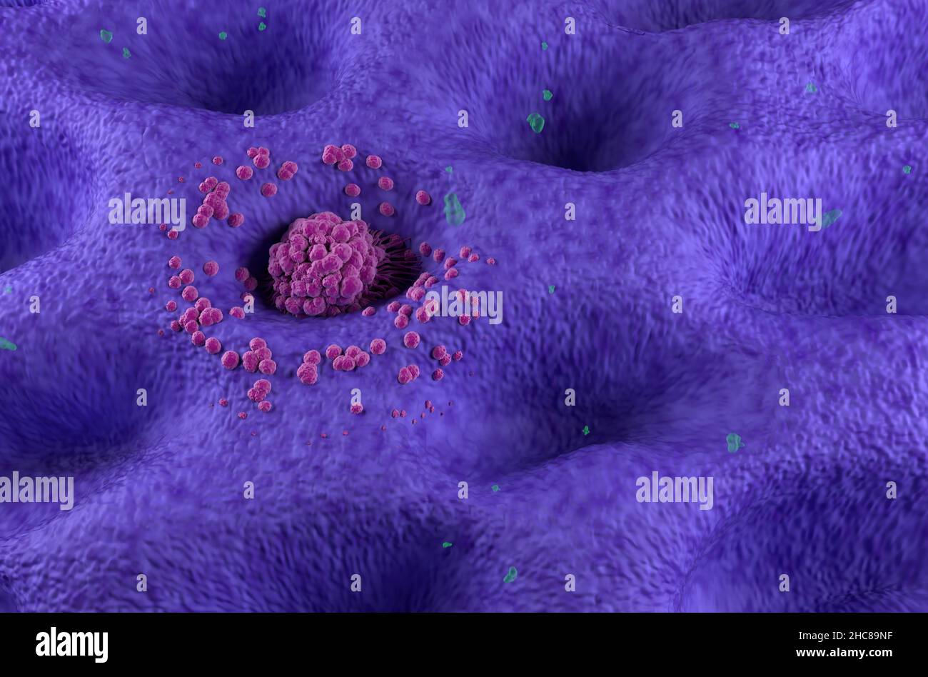 Magenkrebstumor im Frühstadium an der Magenwand isometrische Ansicht 3D Abbildung Stockfoto