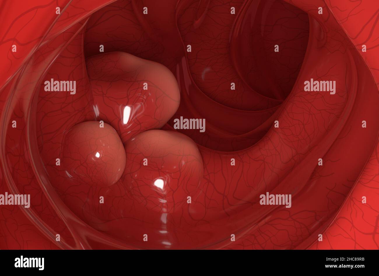 Große Tumoren an der Dickdarmwand bei Dickdarmkrebs Nahaufnahme Ansicht 3D Abbildung Stockfoto