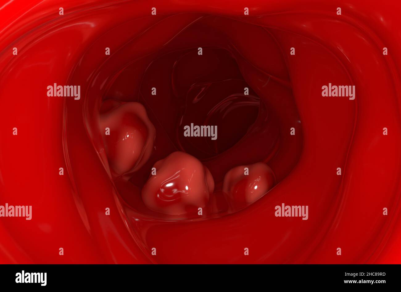 Große Tumoren an der Dickdarmwand bei Dickdarmkrebs 3D Abbildung Stockfoto