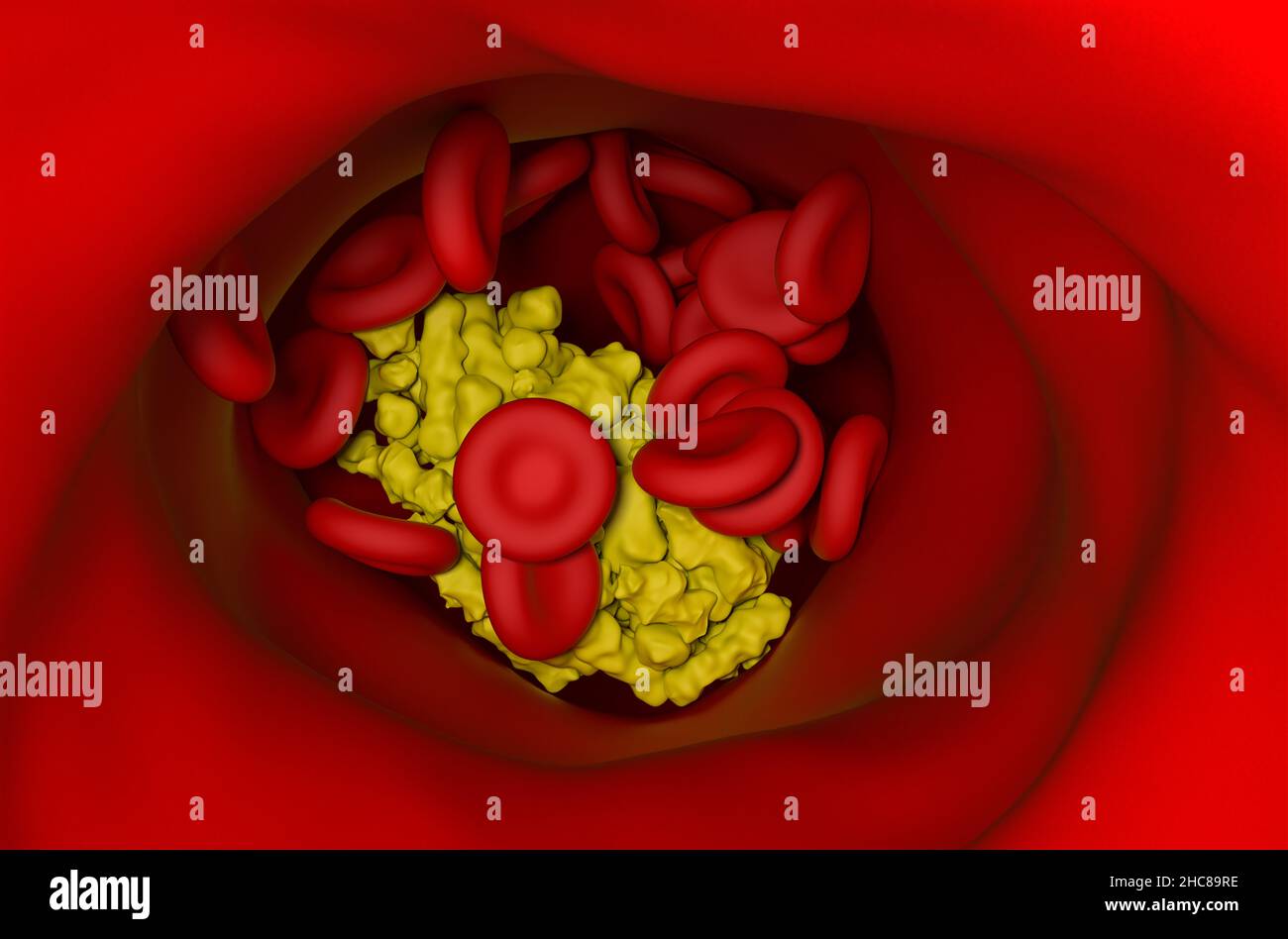 Ein besonders hoher Cholesterinspiegel bildet eine Barriere an einer verstopften Arterienwand gegen die Bewegung der roten Blutkörperchen 3D Stockfoto