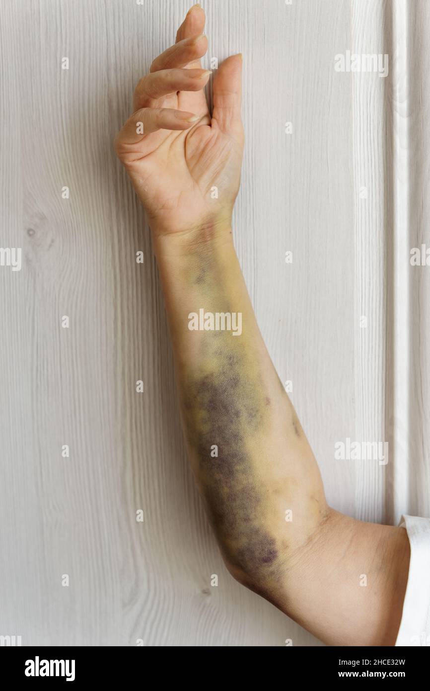 Schwere Blutergüsse am Arm nach koronarer Angioplastie bei einer weiblichen Patientin Schwere Blutergüsse am Arm nach koronarer Angioplastie bei einer weiblichen Patientin