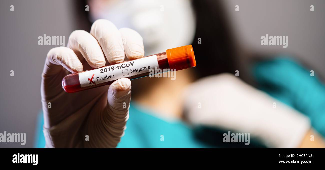 2019-nCoV Coronavirus. Positive Blutprobe in der Hand des Arztes mit Handschuhen. Atemsyndrom. Coronavirus bricht aus Stockfoto
