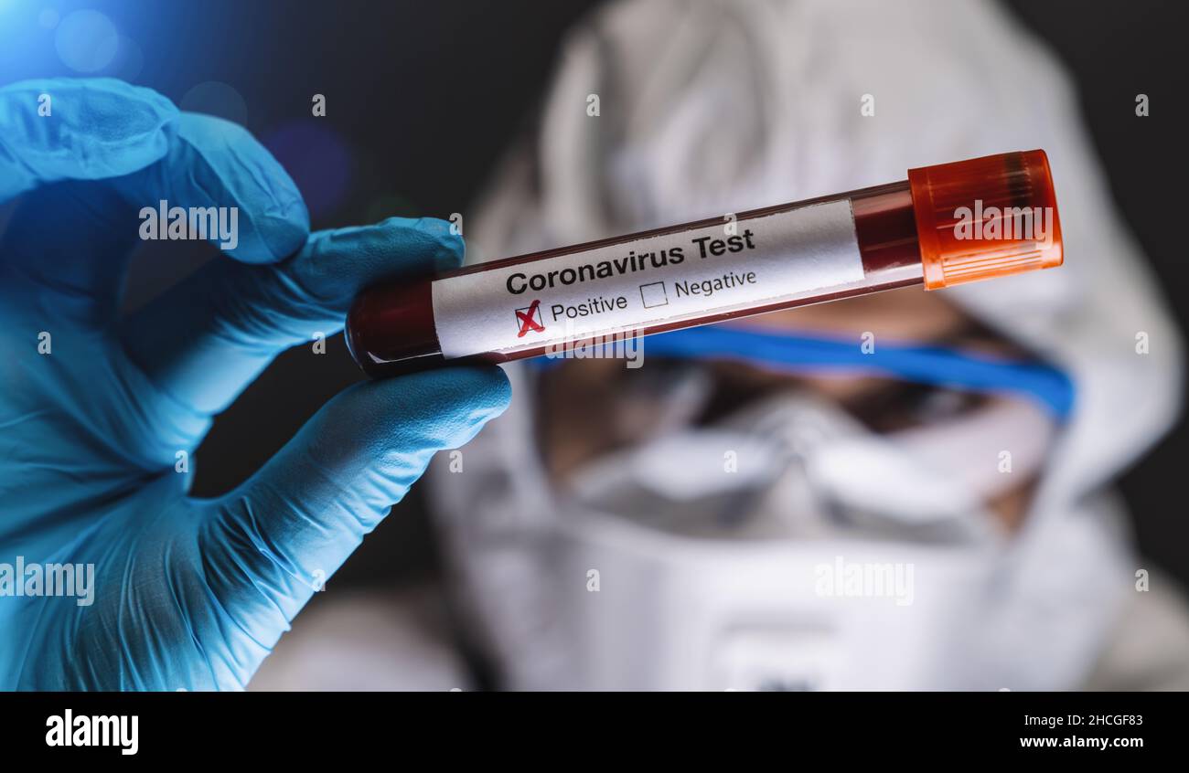 2019-nCoV Coronavirus-Test. Positive Blutprobe in der Hand des Wissenschaftlers. Atemsyndrom. Coronavirus bricht aus Stockfoto