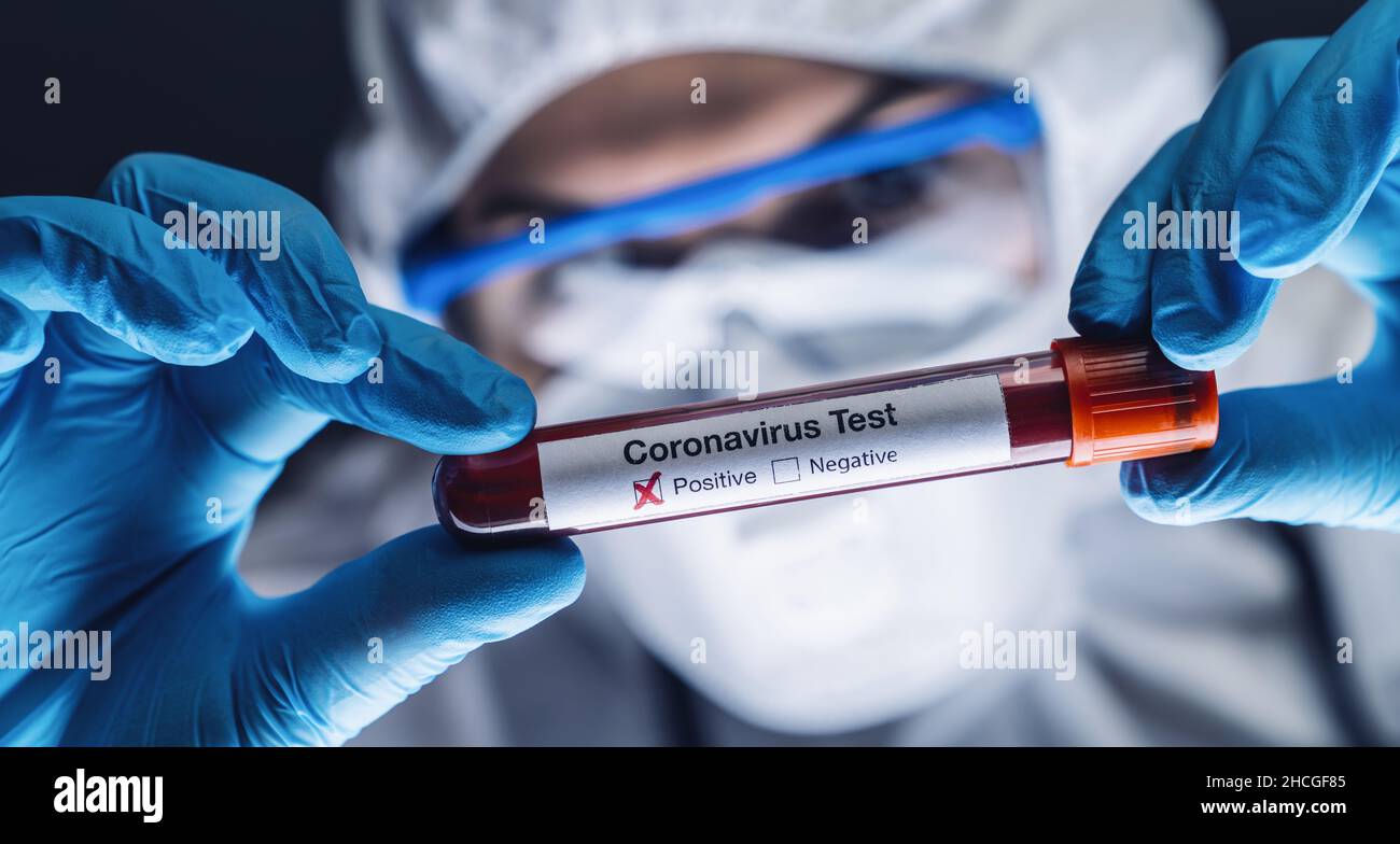 2019-nCoV Coronavirus. Positive Blutprobe in der Hand der Ärzte. Atemwegssyndrom. Coronavirus Outbreaking Stockfoto