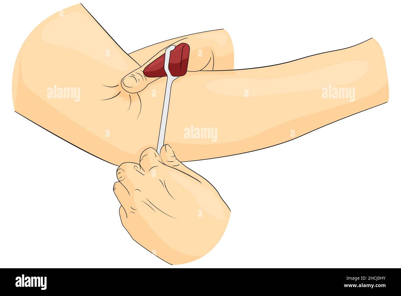 Bizeps-Reflexuntersuchung mit einem Reflexhammer. Neurologische Beurteilung von Bizeps-Brachien. Stockfoto