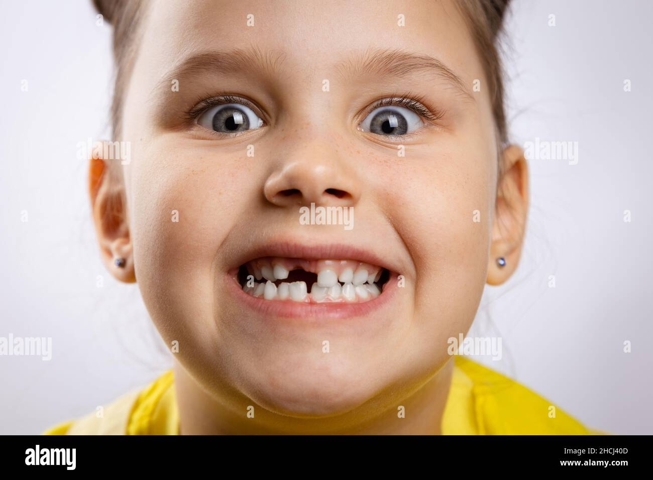 Nahaufnahme von super aufgeregt weiblichen Kind mit geöffnetem Mund zeigt fehlende Front Baby Zahn und wulstende Augen auf weißem Hintergrund. Die ersten Zähne ändern sich Stockfoto