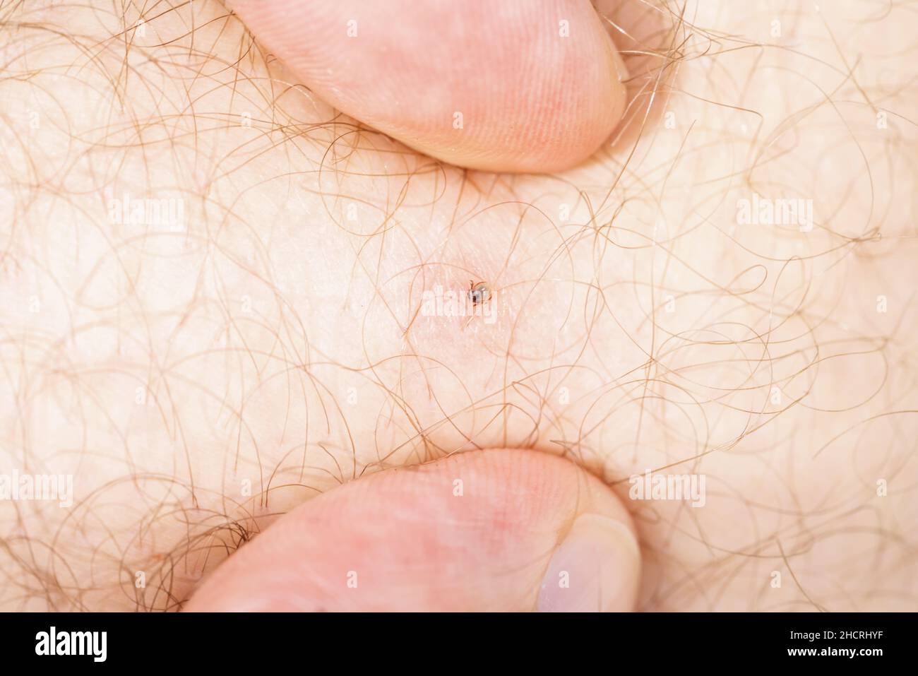Die Menophalitis tickt auf der menschlichen Haut Stockfoto