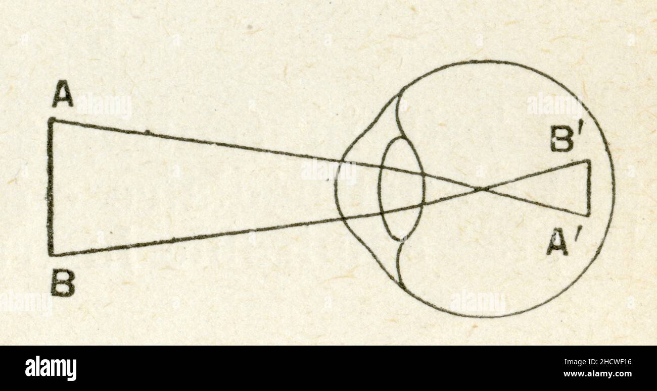 MARCHE DES RAYONS POUR UN OEIL MYOPE Stockfoto