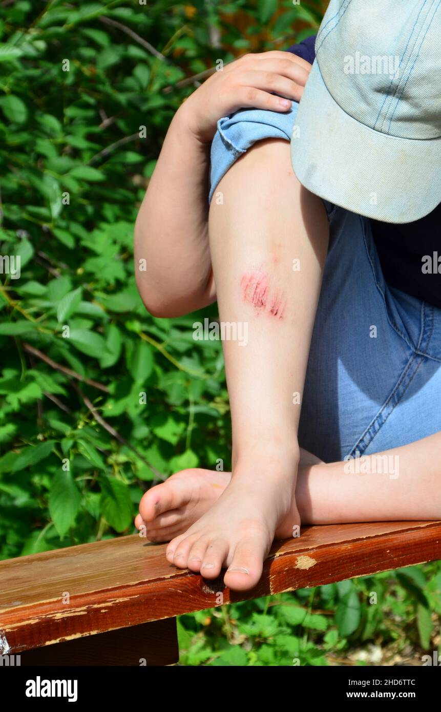 Nahaufnahme des verletzten jungen Kindes Knie, nachdem er auf dem Bürgersteig gefallen, das Bein des Jungen schmerzt. Blutergüsse, Kratzer nach Sommerspaziergängen oder Sport Stockfoto