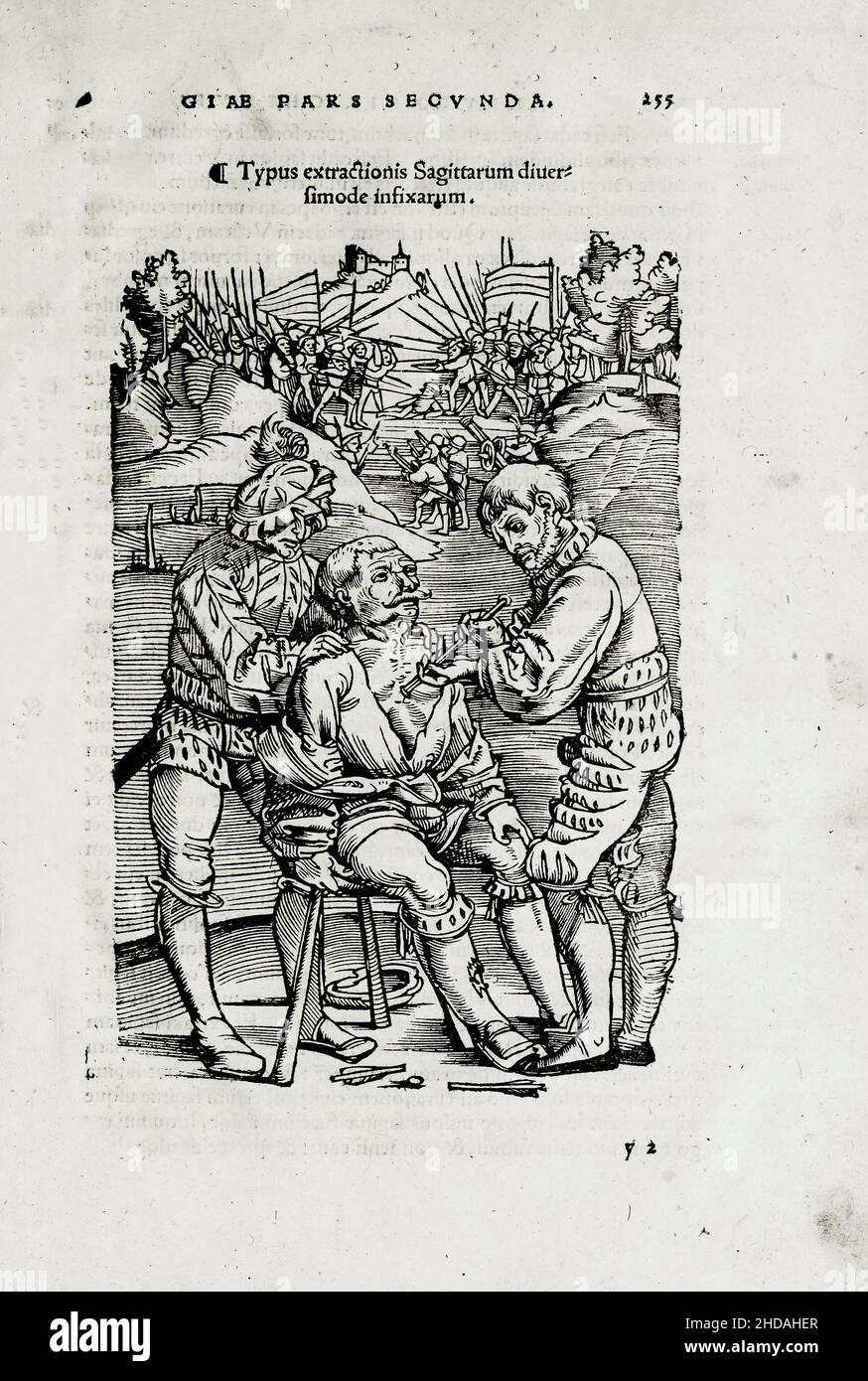 Die 16th. Jahrhundert Illustration der Chirurgie und chirurgischen Operationen im Mittelalter: Chirurgische Entfernung eines Armbrust-Pfeils auf dem Schlachtfeld. Aus dem Stockfoto