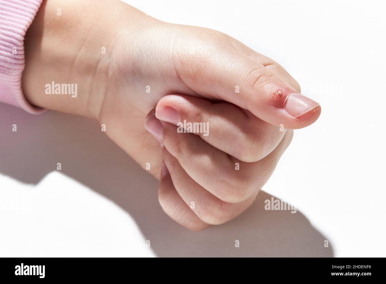 Virale Warze (Verruca) auf dem Finger Nahaufnahme auf weißem Hintergrund. Hauterkrankung, die durch eine Art von humanem Papillomavirus HPV verursacht wird. Stockfoto