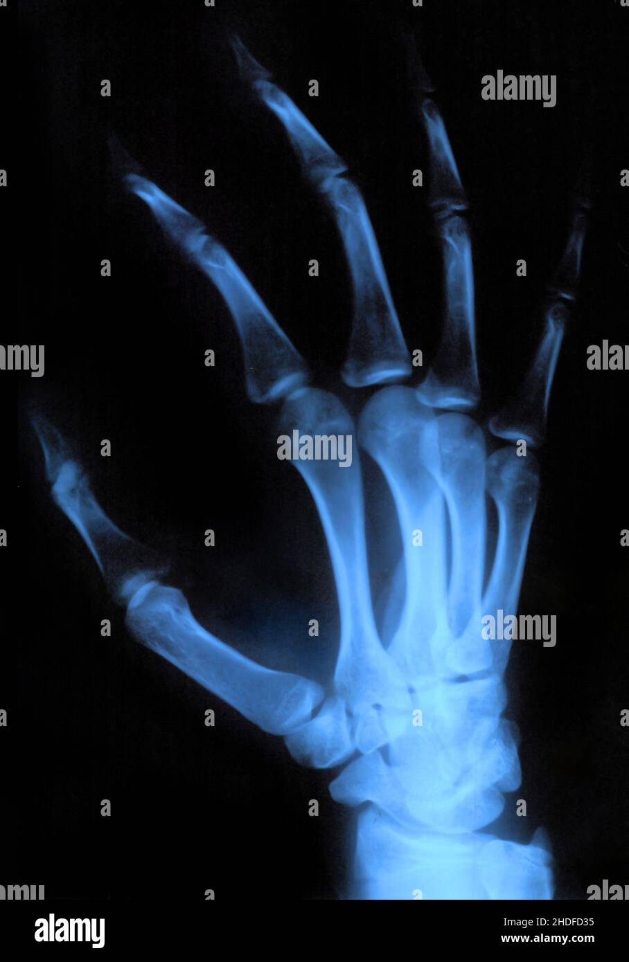 Rontgenbild Einer Hand 1