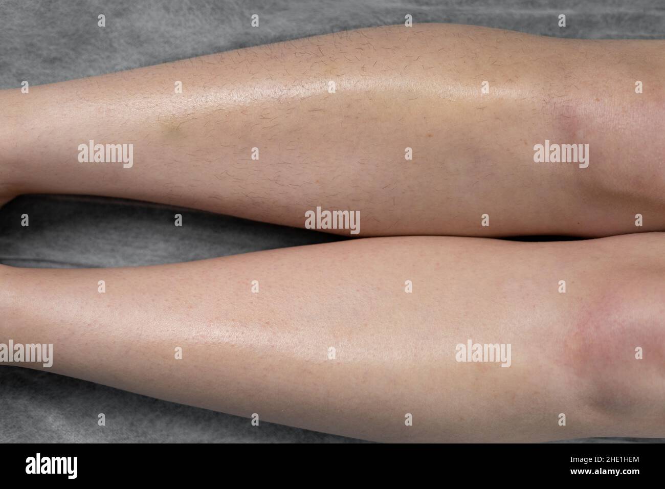 Bild vor und nach Konzept der Haarentfernung an weiblichen Beinen in einem Schönheitssalon. Nahaufnahme Stockfoto