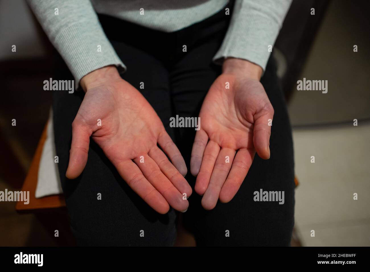 Hände einer Person mit Raynaud-Phänomen während des Angriffs mit einigen Fingern, die nach weißem Farbwechsel blau werden, Raynaud-Syndrom Raynaud-Syndrom Stockfoto
