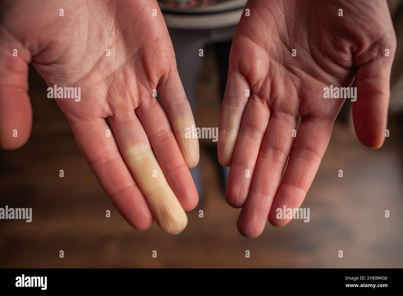Hände einer Person mit Raynaud-Phänomen während eines Angriffs mit einigen weißen Fingern, Farbänderung Raynaud-Syndrom Raynaud-Syndrom Stockfoto