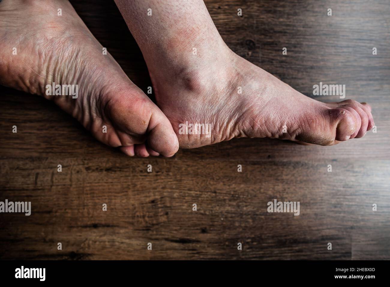 Füße einer Person mit Raynaud- und Ehlers-Danlos-Syndrom (EDS) mit geschwollenen Zehen, geschädigter, sehr trockener, gereizter Haut, Raynaud-Syndrom, Krankheitsschmerz Stockfoto